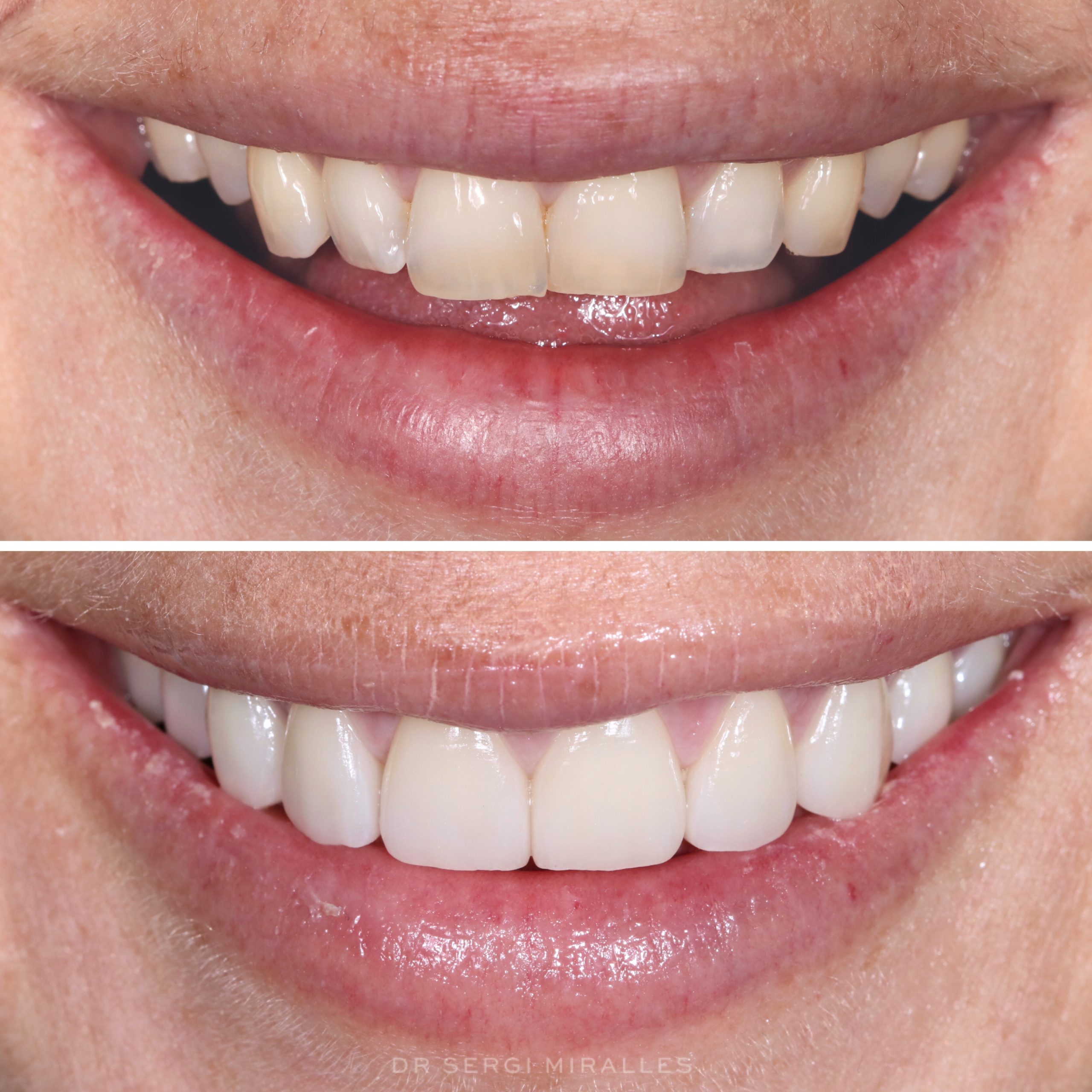 Smile Makeover